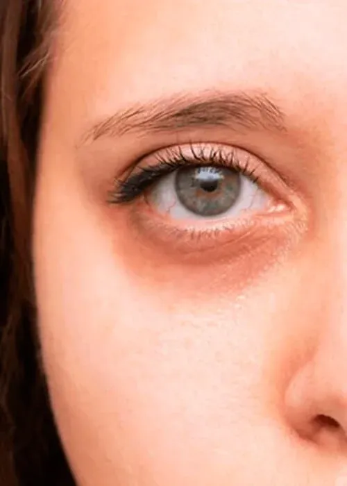 Blepharoplasty Treatment in Nairobi