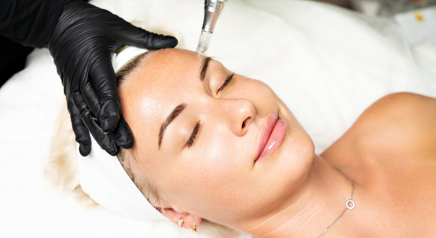 Microneedling facial treatment in progress.
