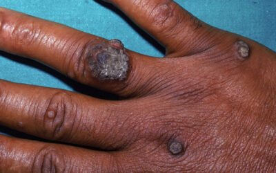 5 Common Myths of Warts that People Think are True & How They Are Treated