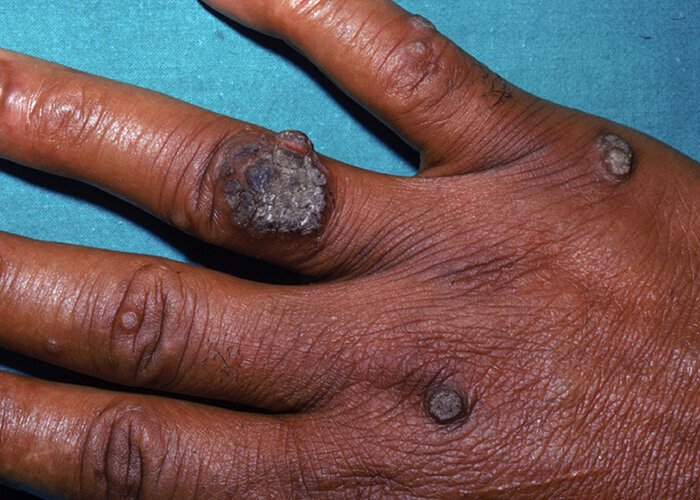 Warts treatment in Nairobi