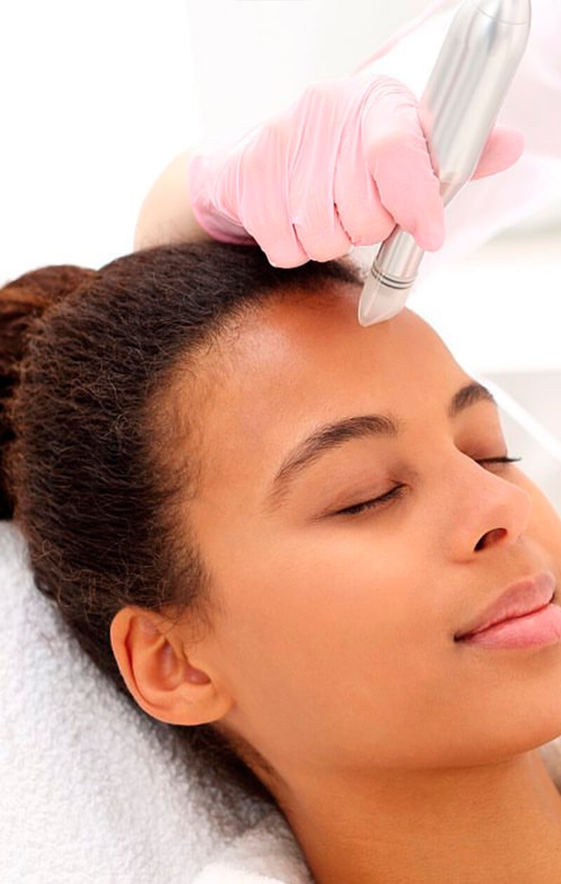 Microneedling