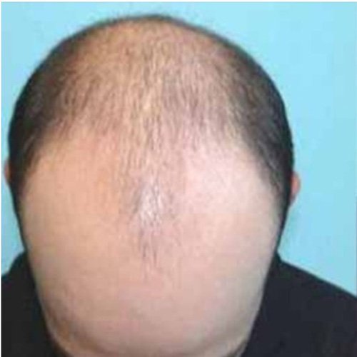 Non-Surgical Hair Transplant in Nairobi