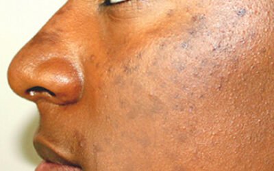 Laser Hyperpigmentation Treatment in Nairobi