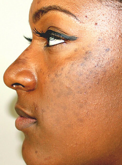 Laser Hyperpigmentation Treatment in Nairobi