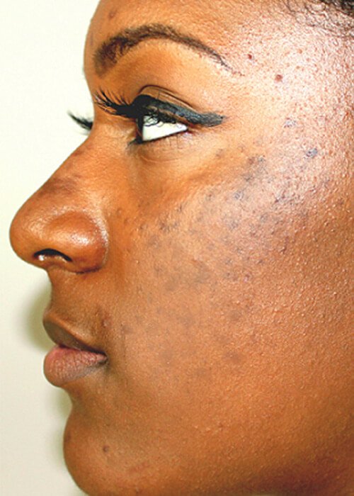 hyperpigmentation condition