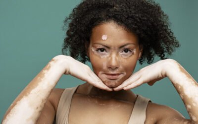 Laser Vitiligo Treatment