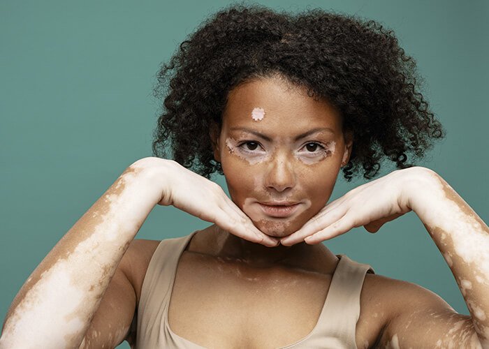 Vitiligo