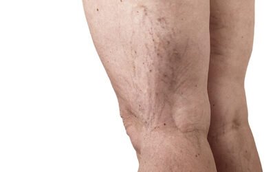 Varicose Veins Treatment in Nairobi