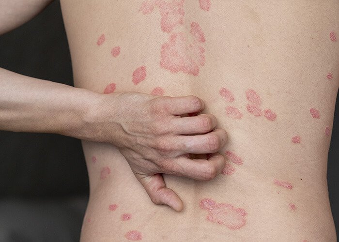 Psoriasis