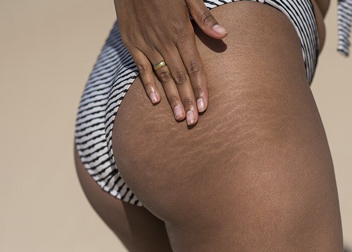 stretch marks