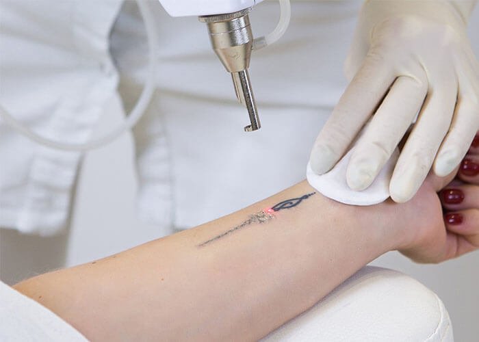 tattoo removal