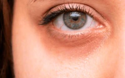 Blepharoplasty Treatment in Nairobi￼