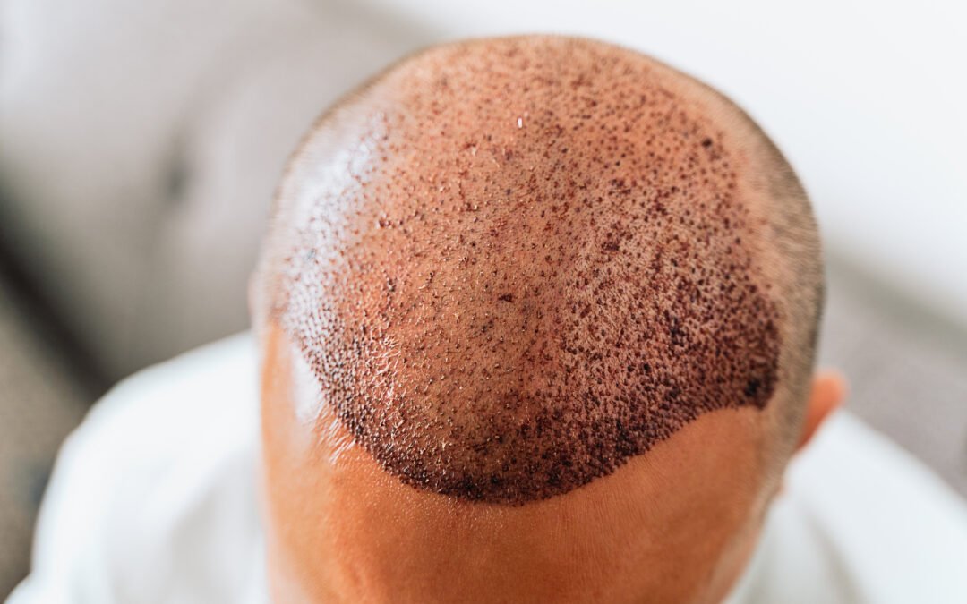 Cost of Hair Transplant in Kenya