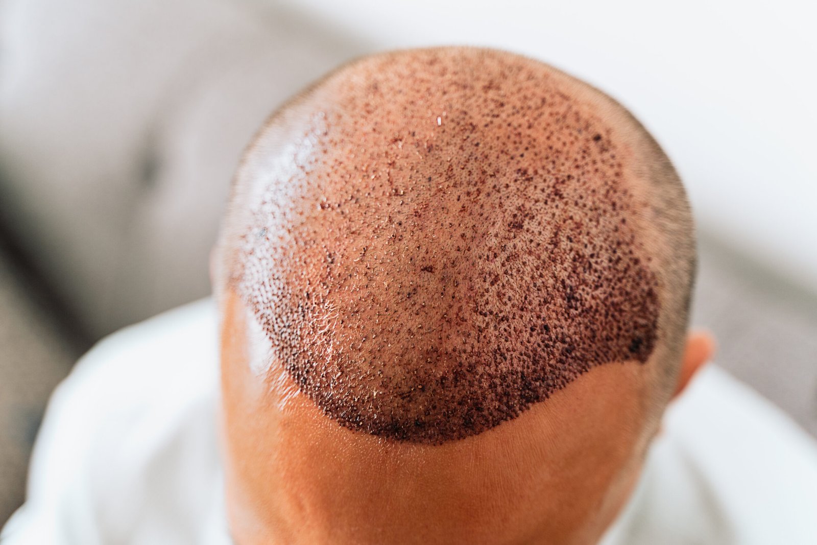 hair transplantation